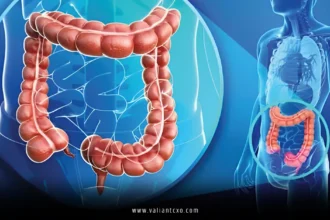 Colorectal Cancer
