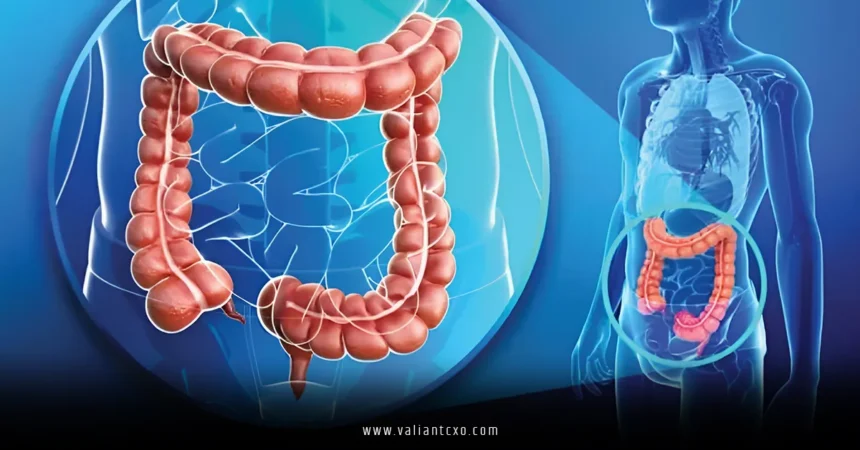Colorectal Cancer