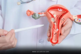 Endometriosis
