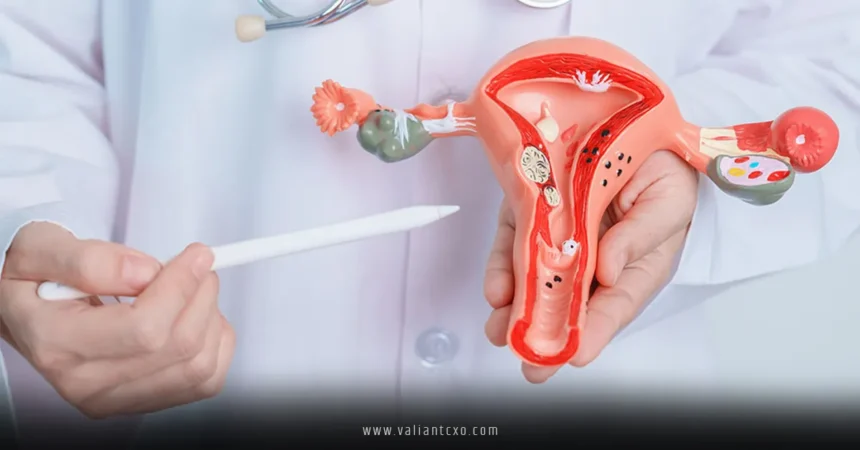 Endometriosis
