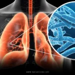 Legionnaires Disease Understanding the Silent Threat
